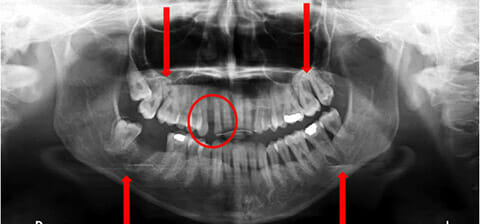 panoramica di un paziente parodontale prima della terapia