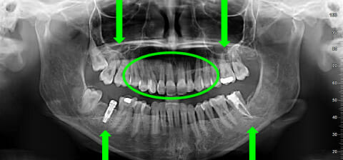 panoramica di un paziente parodontale dopo la terapia