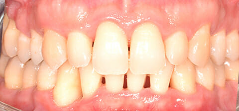 paziente dopo la terapia per la parodontite