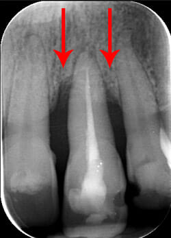 recessione ossea causata dalla parodontite