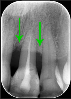 ricrescita ossea spontanea post terapia parodontale