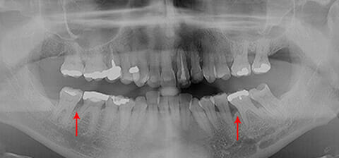 opt paziente parodontale