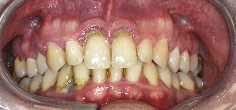 paziente prima della terapia per la parodontite