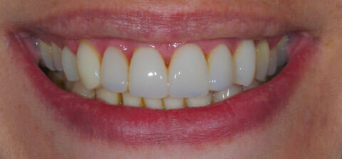 foto della bocca di un paziente parodontale dopo terapia parodontale ed estetica