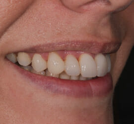 foto della bocca di un paziente parodontale dopo terapia parodontale ed estetica