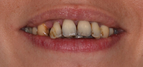 foto della bocca di un paziente parodontale