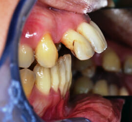 foto della bocca di un paziente parodontale