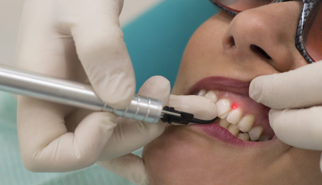 cura laser per la parodontite